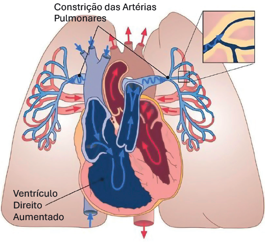 Coração na Hipertensão Pulmonar
